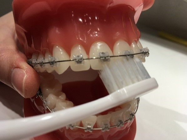 矯正治療中の歯磨きについて 仙台東口矯正歯科 医院ブログ