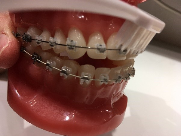 矯正治療中の歯磨きについて 仙台東口矯正歯科 医院ブログ