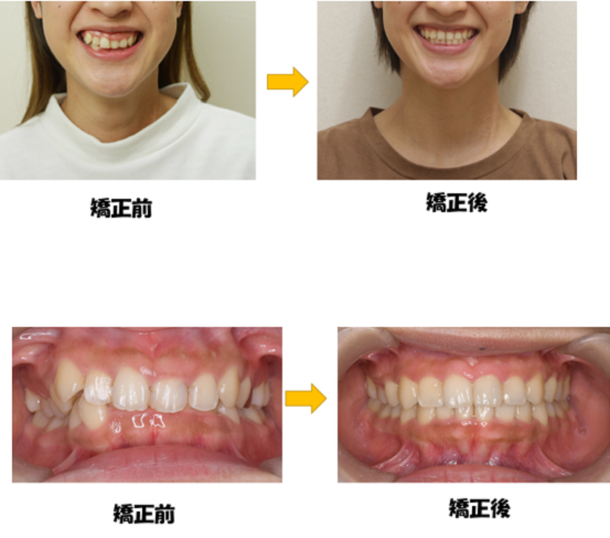 わたしも矯正経験者です 仙台東口矯正歯科 医院ブログ