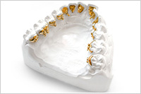 5. ブラケットは表面処理され、装着用のトレーがつくられる。このトレーは、患者さまのすべての歯に、ブラケットを正確に接着するための型となる。