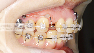 上顎左右は抜歯スペースの閉鎖、上顎前歯部は上顎前歯の圧下を行っています。