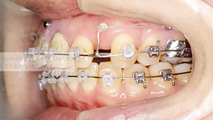 上顎左右は抜歯スペースの閉鎖、上顎前歯部は上顎前歯の圧下を行っています。