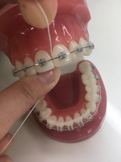 矯正治療中のデンタルフロスの使い方