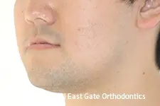 治療前