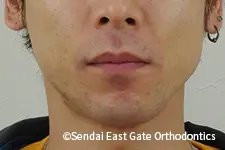 治療前