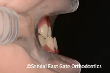 治療前