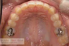 治療後