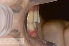 治療後