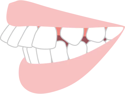 上の歯が出ている