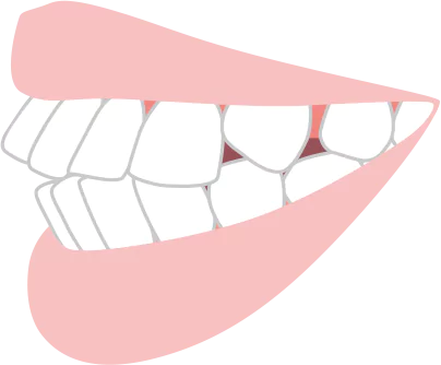 上と下の前歯が出ている