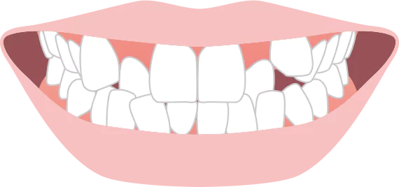 歯が凸凹に生えている