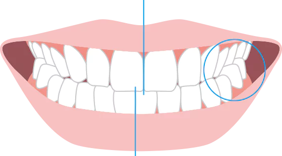 あごが、横にずれている