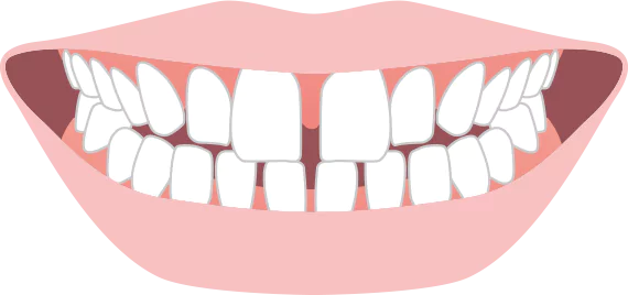 歯の間にすき間がある